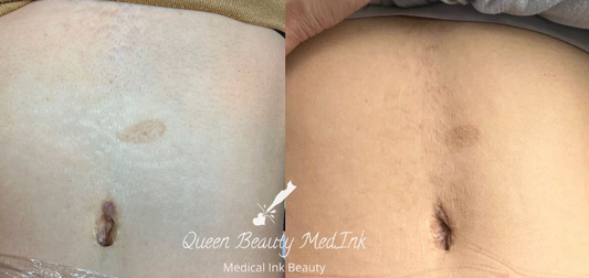 What is Scar and Stretch Mark Camouflage ?