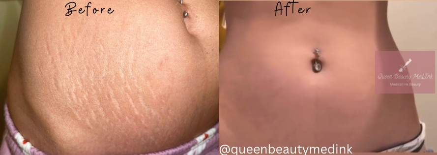 Stretch Mark Removal