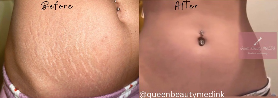 What is Inkless Stretch Mark Removal?